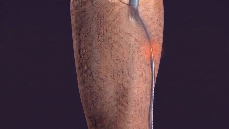 Act IV, Treatment: a still from the vein journey