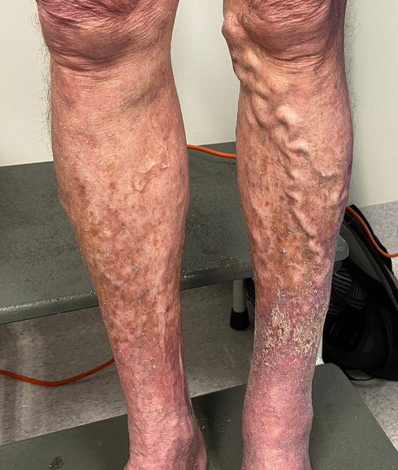 Supplied clinical photograph of visible varicose veins in both legs