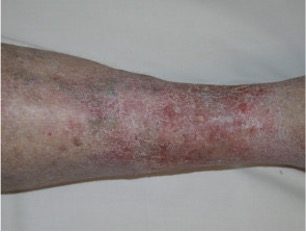Supplied clinical photograph labelled venous eczema, showing lower-leg skin changes